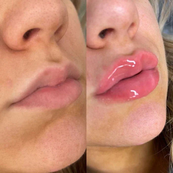 Achieve Fuller Lips Quickly with Lip Plumper Serum