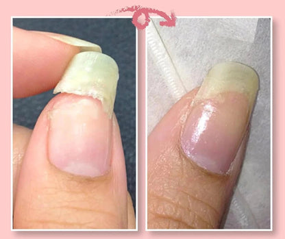 NailGuard Pro - Effortlessly Fix Your Broken Nails