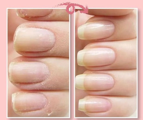 NailGuard Pro - Effortlessly Fix Your Broken Nails