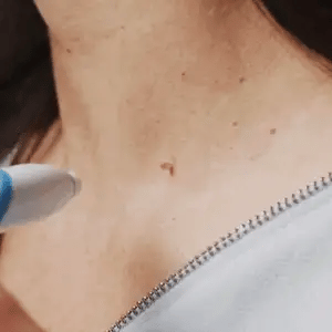 Mole Removal Kit for Skin - Eliminate Auto Skin Moles