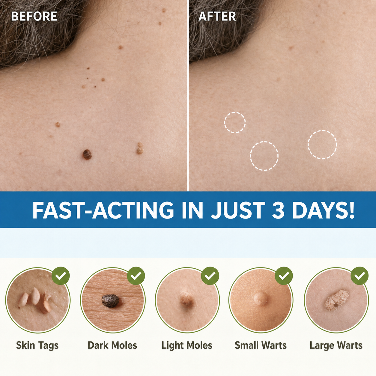 Gentle Skin Tag Remover Patches | Pain-Free Solution at Home