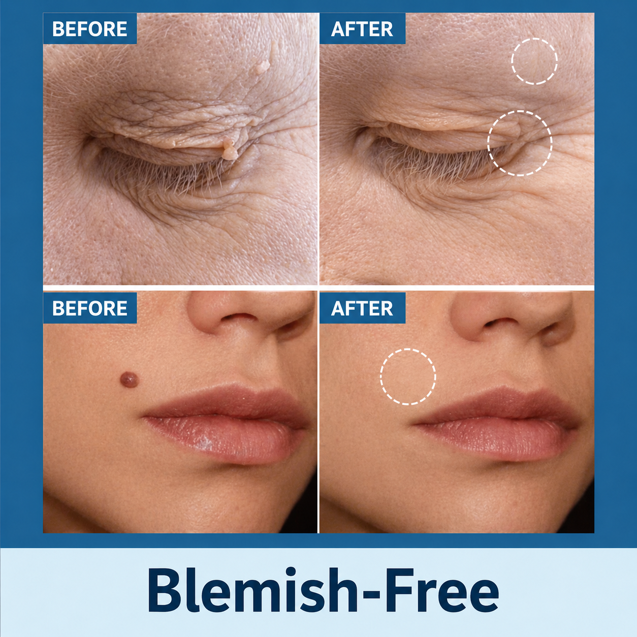 Gentle Skin Tag Remover Patches | Pain-Free Solution at Home