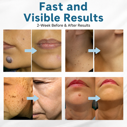 Revitalize Your Skin at Home with Precision Laser Treatment