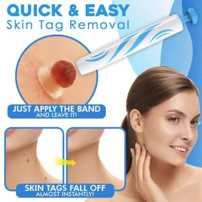 Mole Removal Kit for Skin - Eliminate Auto Skin Moles