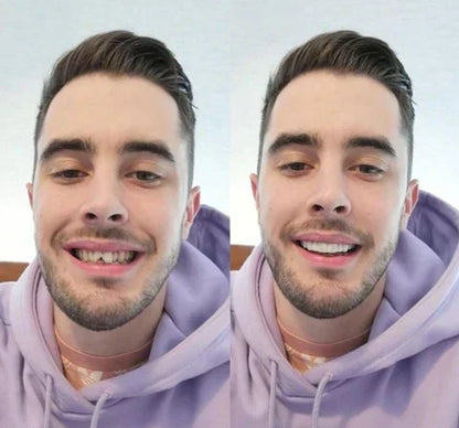 Snap-On Veneers for Upper and Lower Teeth – Quick Natural Smile Solution