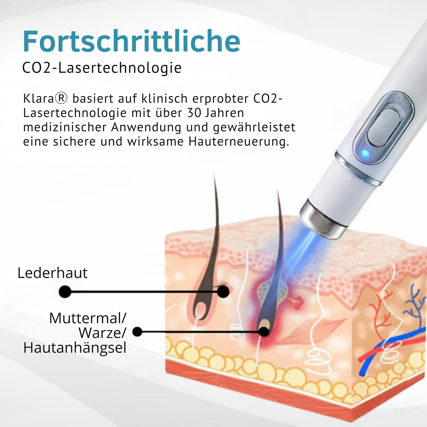 RadiantGlow™ Pain-Free Laser Pen – Reveal Flawless Skin Anytime
