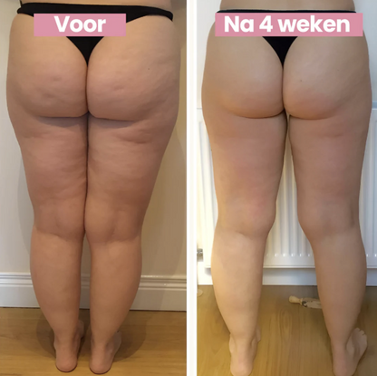 Anti-Cellulite and Skin Tightening Treatment – SmoothLift