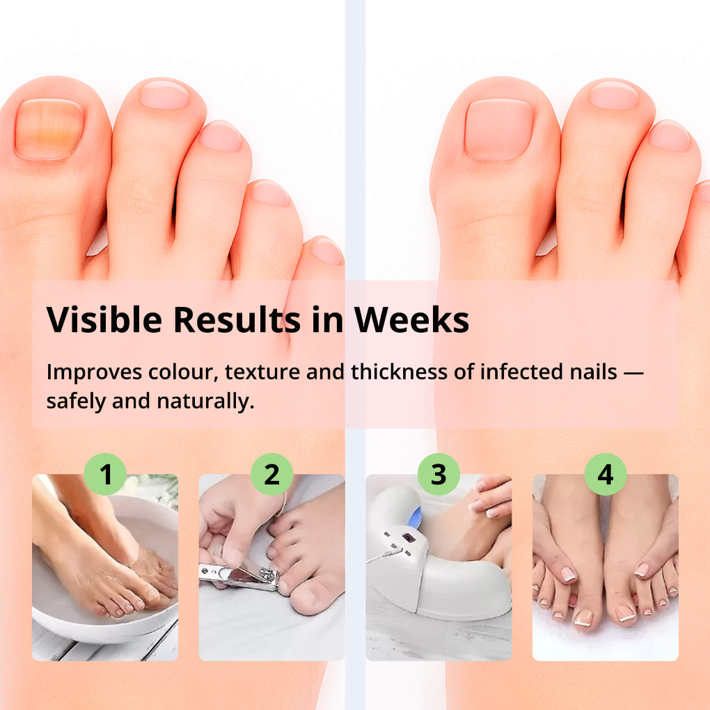 Nail Treatment Device with Laser Technology – Red & Blue Light for Fungal Nails