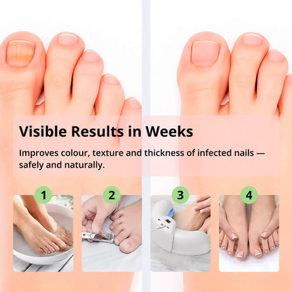 Nail Treatment Device with Laser Technology – Red & Blue Light for Fungal Nails