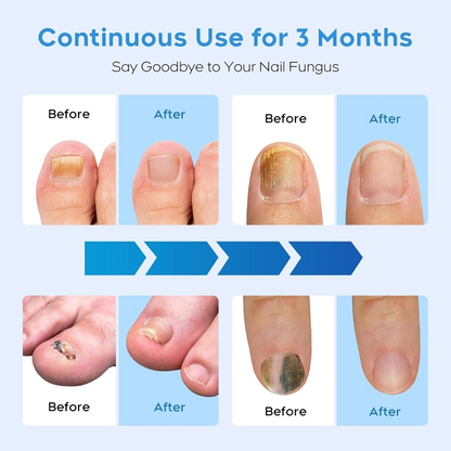 ReviveNail Laser Treatment | Eliminate Nail Fungus Effectively!