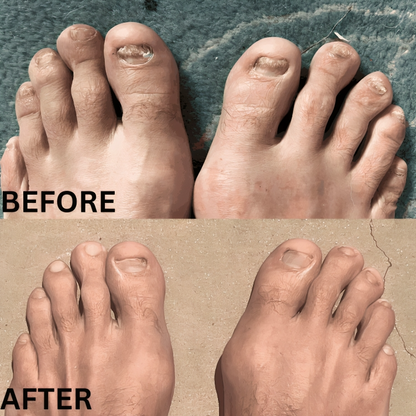ReviveNail Laser Treatment | Eliminate Nail Fungus Effectively!