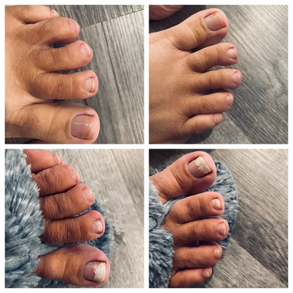 ReviveNail Laser Treatment | Eliminate Nail Fungus Effectively!