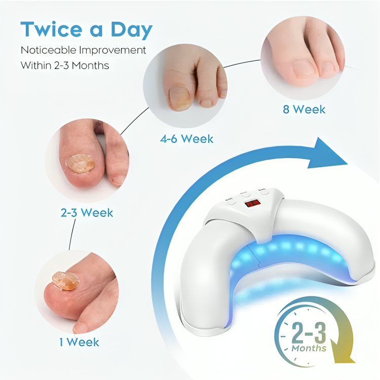 ReviveNail Laser Treatment | Eliminate Nail Fungus Effectively!
