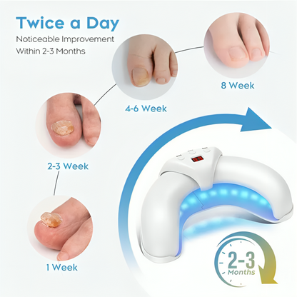 ReviveNail Laser Treatment | Eliminate Nail Fungus Effectively!