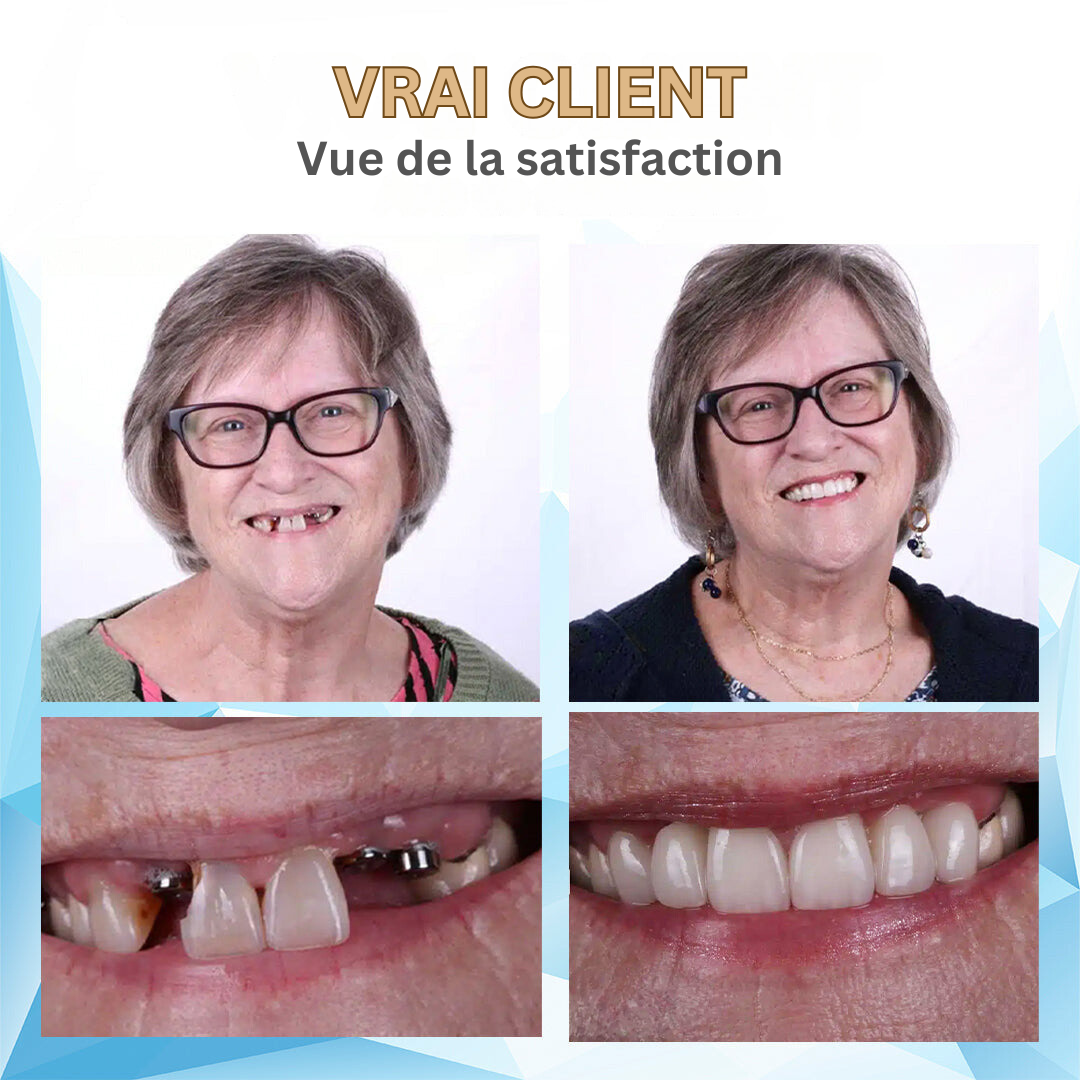 SoftFix Mouthpiece | Experience the Comfort of an Affordable Denture
