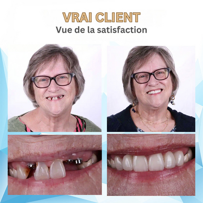 SoftFix Mouthpiece | Experience the Comfort of an Affordable Denture