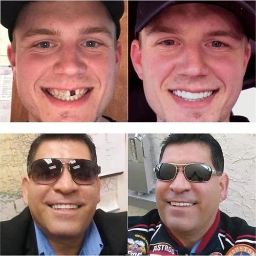 Instant Confidence Dental Prosthetic | Effortless Smile Transformation