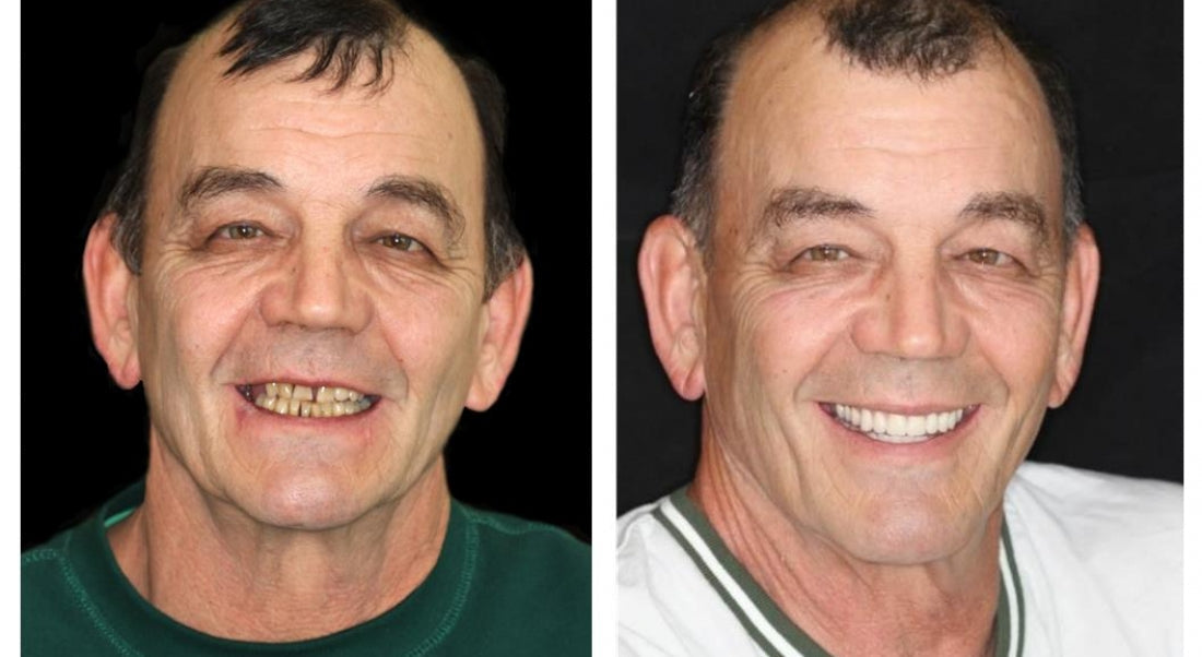Transformative Custom Full Denture Set - Limited Time Offer!