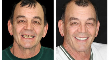 Transformative Custom Full Denture Set - Limited Time Offer!