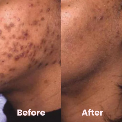 GlowBoost Pads | Turmeric and Kojic Acid Treatment