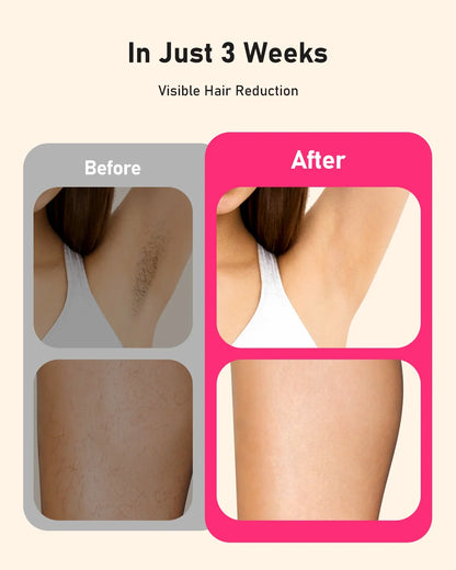 At-Home Hair Removal Device with 999,999 Flashes, 9 Energy Levels, Auto & Manual Modes