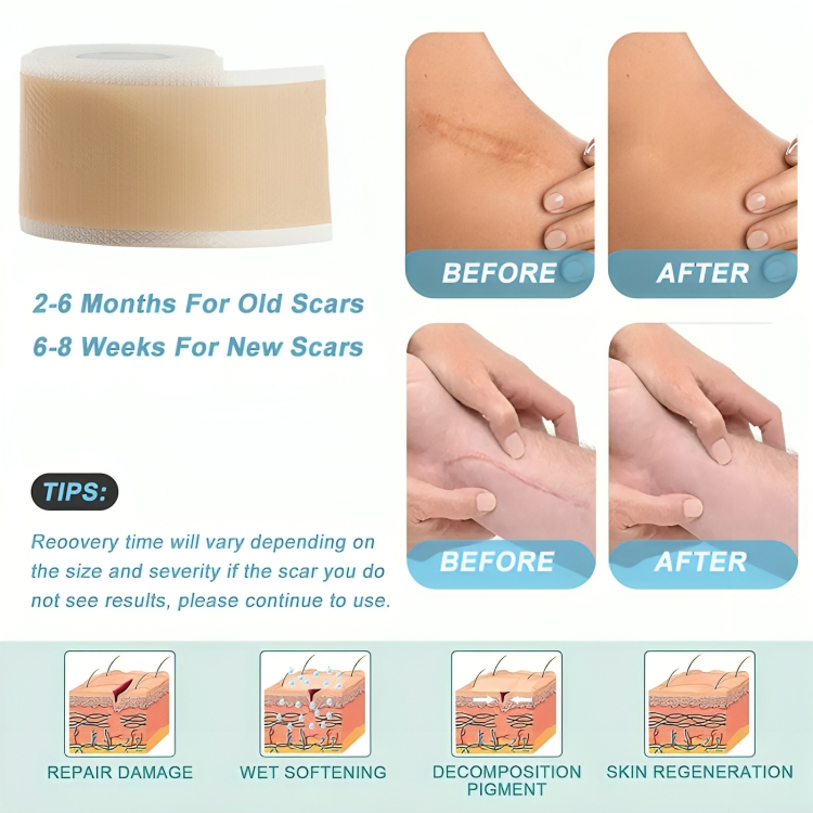 ScarAway® | Silicone Scar Treatment Sheets
