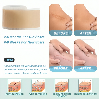 ScarAway® | Silicone Scar Treatment Sheets