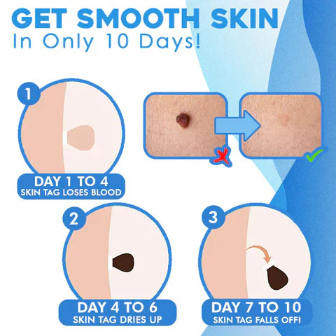 Mole Removal Kit for Skin - Eliminate Auto Skin Moles