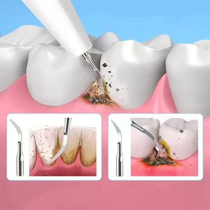 Ultrasonic Dental Cleaner – Electric Tartar Removal Device for Home Use