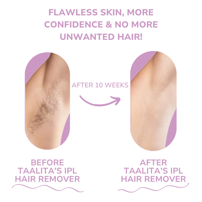 SoftLight IPL Hair Removal Device for Gentle At-Home Hair Removal