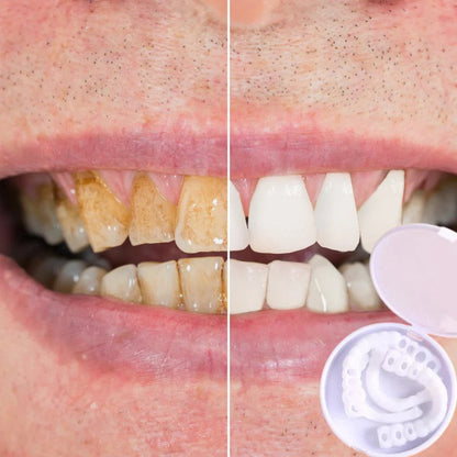 Transform Your Smile with Instant Dental Veneers