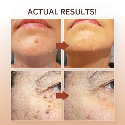 SmoothSkin Eliminator | Precision Applicator for Spot Treatment | Natural Care Formula