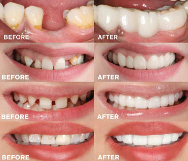 Instant Smile Solution | No Adhesive Needed | Custom Fit