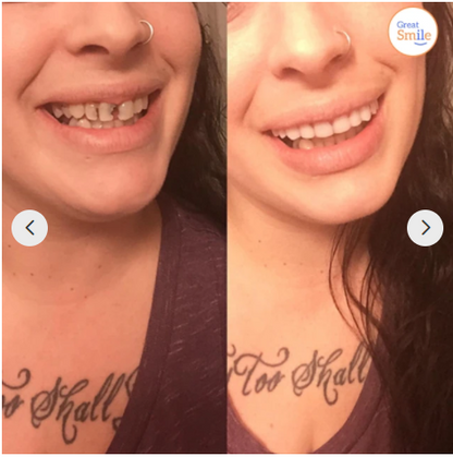 Instant Smile Solution | No Adhesive Needed | Custom Fit