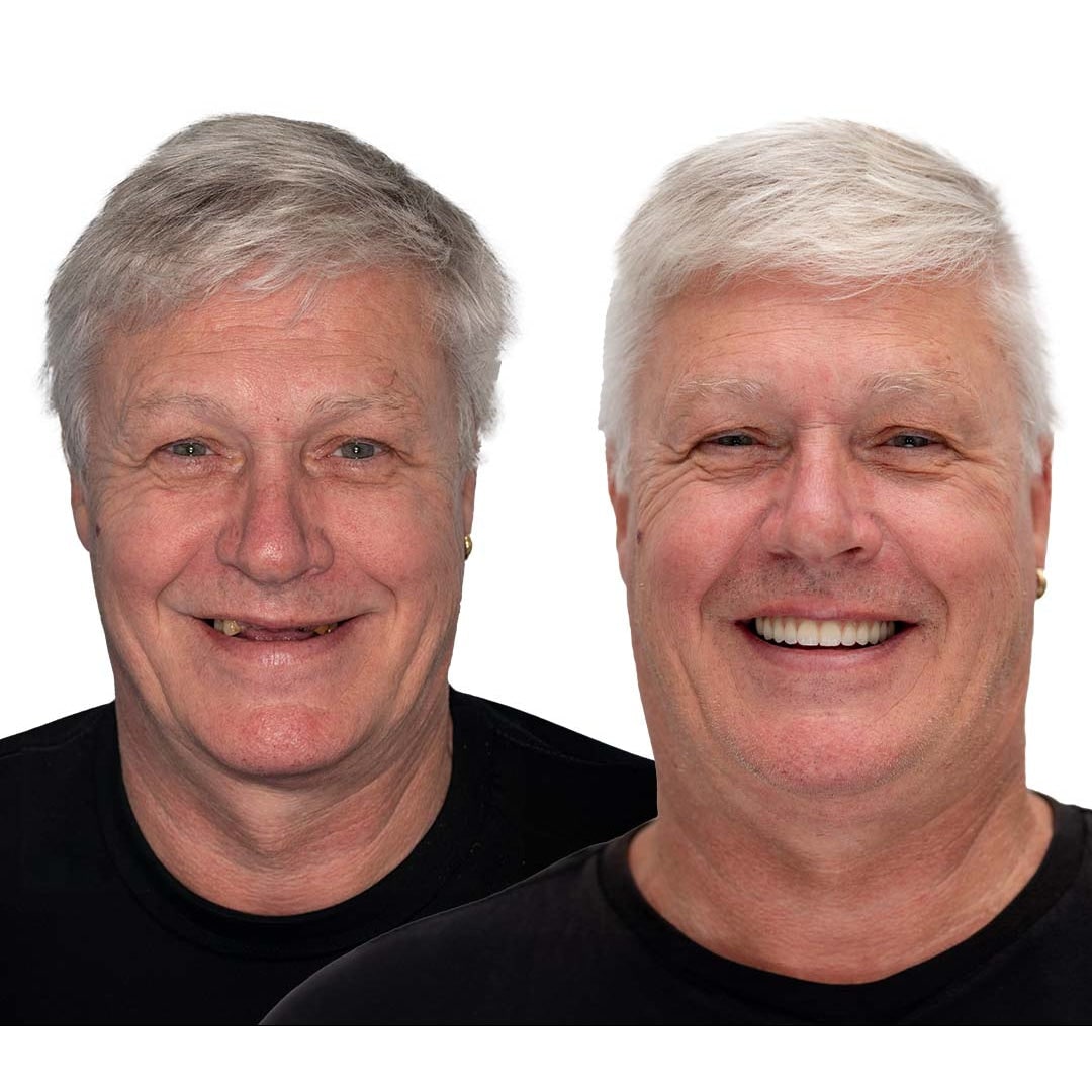 Affordable Flexible Comfort Denture Set for a Natural Smile