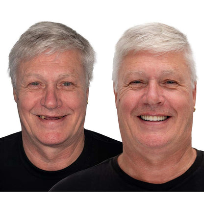 Affordable Flexible Comfort Denture Set for a Natural Smile