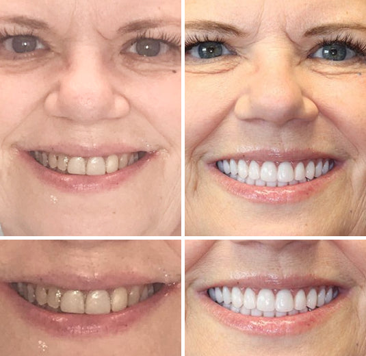 Transformative Custom Full Denture Set - Limited Time Offer!