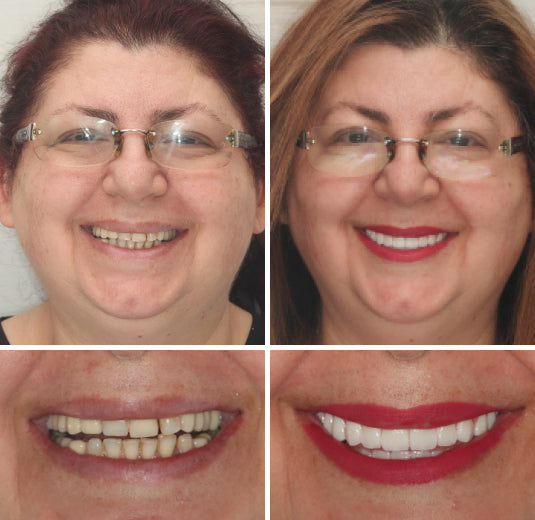 Transformative Custom Full Denture Set - Limited Time Offer!