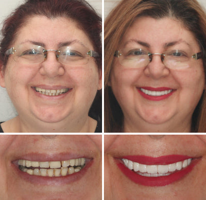 Transformative Custom Full Denture Set - Limited Time Offer!