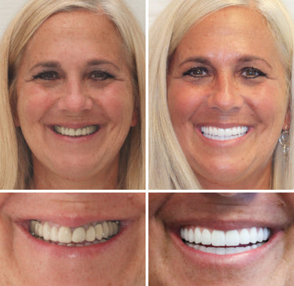 Transformative Custom Full Denture Set - Limited Time Offer!