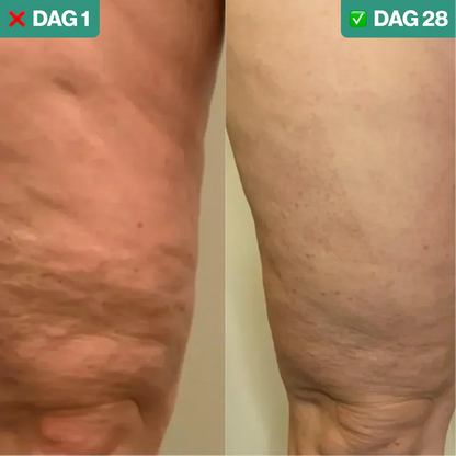 Anti-Cellulite and Skin Tightening Treatment – SmoothLift