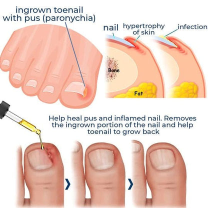 NailCare Relief Oil for Effective Ingrown Toenail Treatment