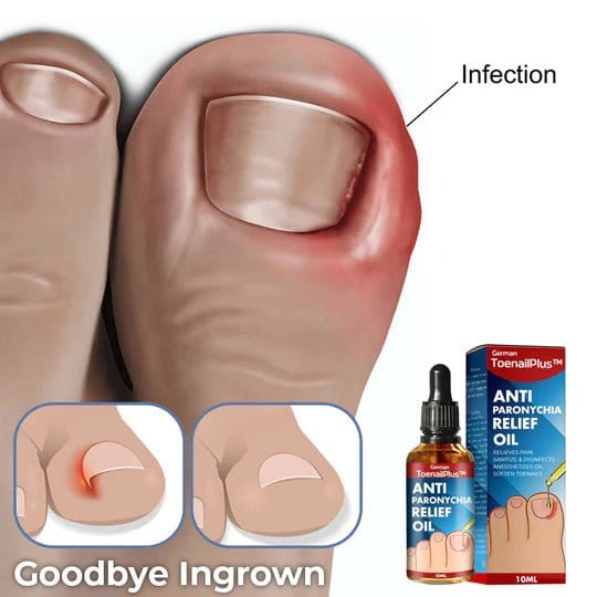 NailCare Relief Oil for Effective Ingrown Toenail Treatment