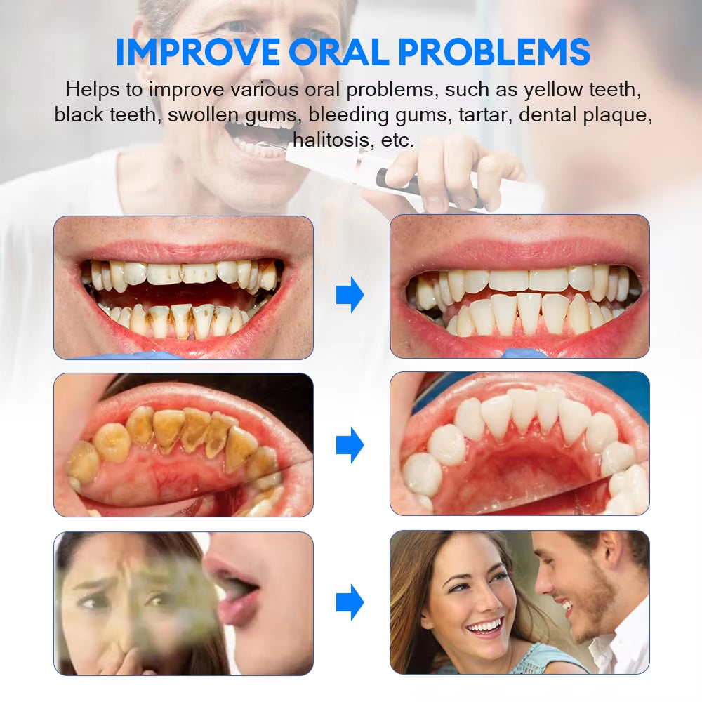 Plaque and Tartar Remover with High-Frequency Sound Wave Technology