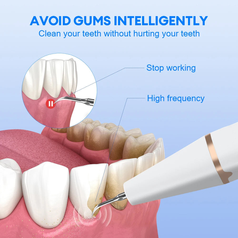 Plaque and Tartar Remover with High-Frequency Sound Wave Technology