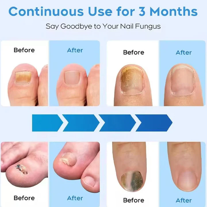 Nail Fungus Treatment Laser Device