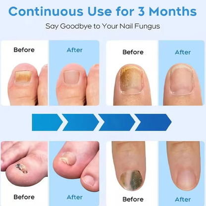 Nail Fungus Treatment Laser Device