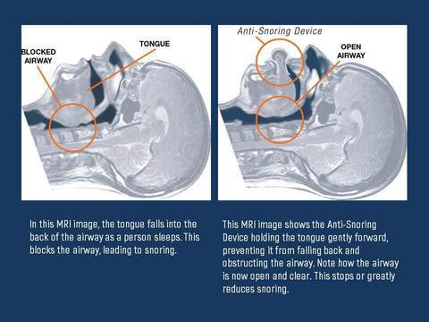 Tongue Stabilizer for Sleep Apnea Management Device