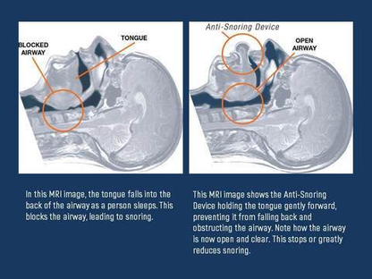 Tongue Stabilizer for Sleep Apnea Management Device