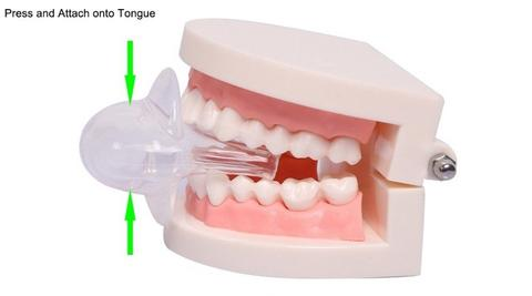Tongue Stabilizer for Sleep Apnea Management Device